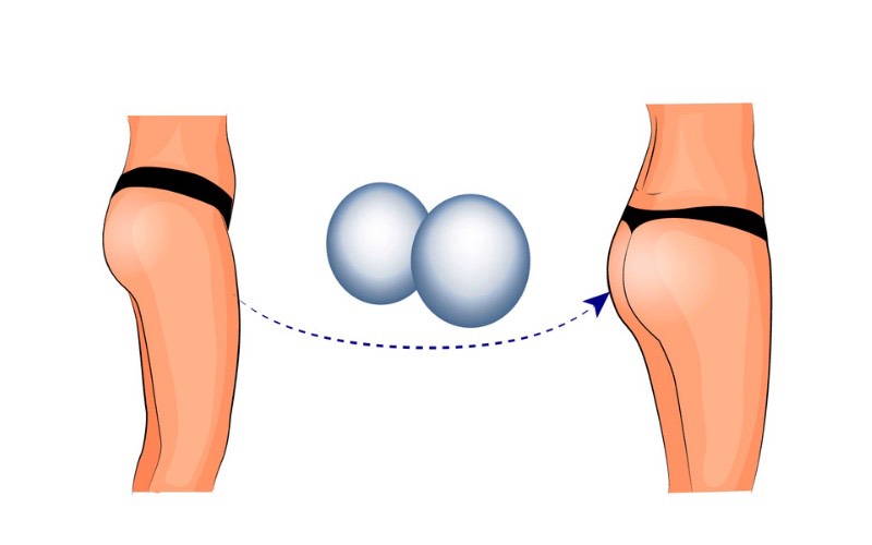 Phẫu thuật độn mông giá bao nhiêu
