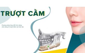 phẫu thuật trượt cằm giá bao nhiêu