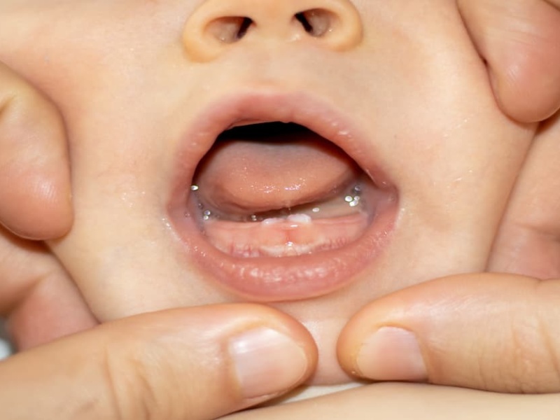Dấu hiệu sữa mẹ thiếu chất qua hiện tượng chậm mọc răng của bé
